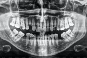 تصویر ایکس-ری از دندان انسان